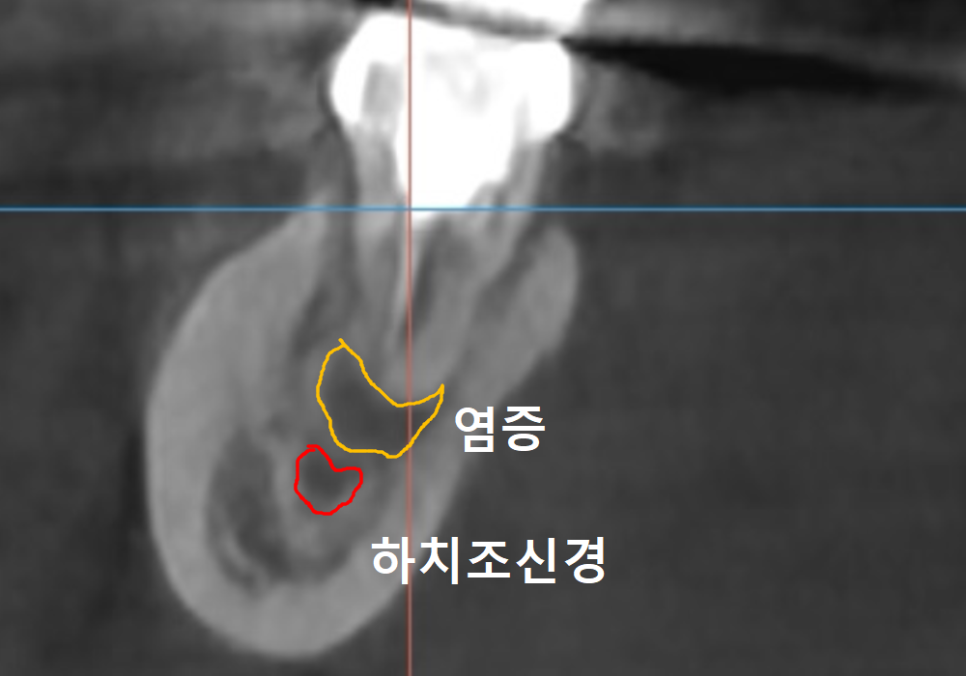 강동구 임플란트 기간, 사람마다 왜 다를까? 즉시식립과 지연식립의 결정적 차이 관련 이미지 6