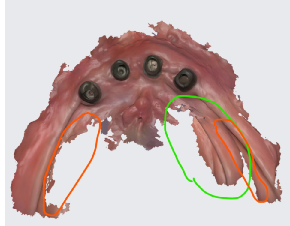 올온포 치아가 다 없어도 임플란트 4개만으로 복원이 가능합니다 관련 이미지 3