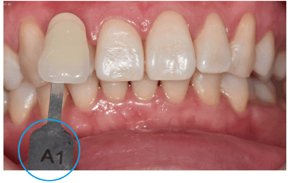 상일동 치아미백 가격, 횟수 궁금하신 부분 싹 정리했습니다. 관련 이미지 1