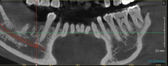 이 흔들림으로 발치 후 뼈이식 진행한 케이스 관련 이미지 9
