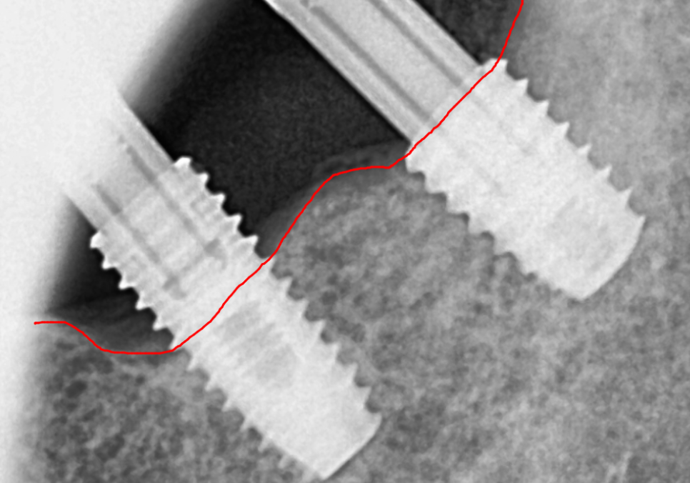 천호동 임플란트 재식립 사례, 평생 쓰는 줄 알았는데? 관련 이미지 12