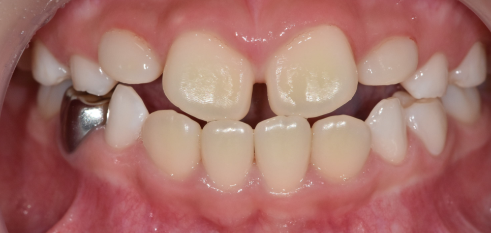 소아 악궁확장 RPE장치란? 성장기 1차 교정 진행해야할 때 관련 이미지 2