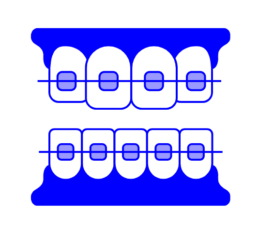 치아 교정기 종류 결정장애 환자분들을 위한 친절한 설명서 관련 이미지 2