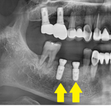임플란트 뚜껑 빠짐 시공이 잘못된거 아냐? 생각이 들으셨다면 관련 이미지 7