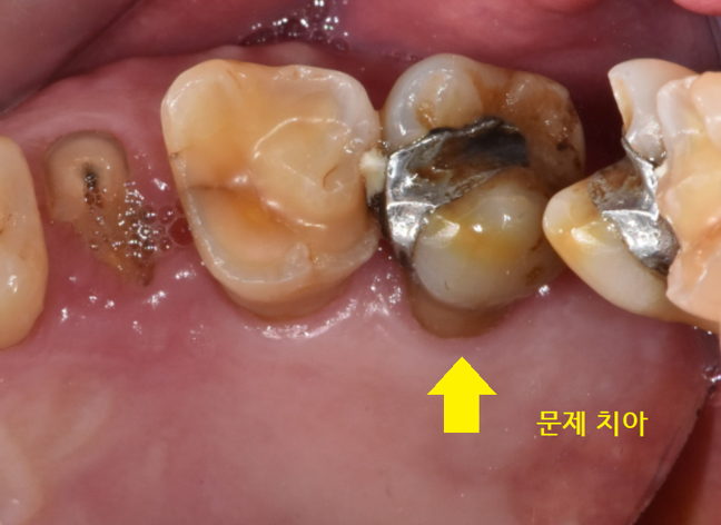 강일동 치과 치아 부러짐 붙일 수 있을까요?? 관련 이미지 7