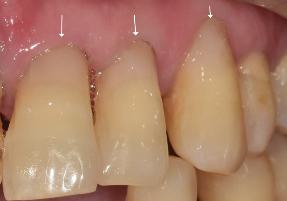 치아 시림 증상 때문에 고민이신가요? 그렇다면 양치질 너무 열심히 하지 마세요. 관련 이미지 6
