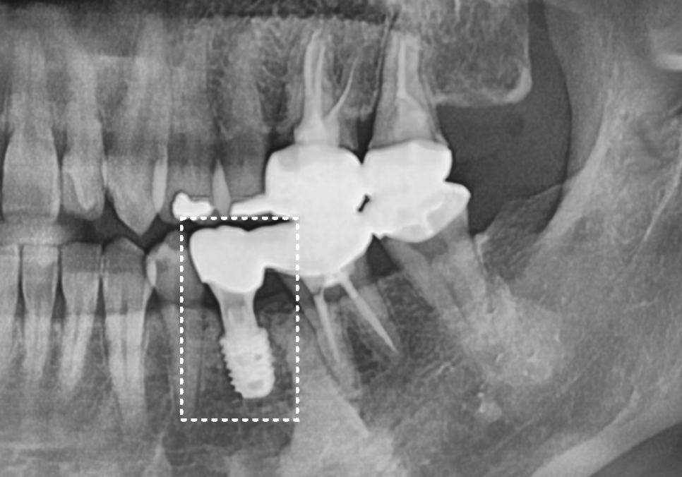 아말감 파절, 조금 깨졌을 뿐인데, 2차 충치로 치아 절반이 깨진 사연 관련 이미지 12