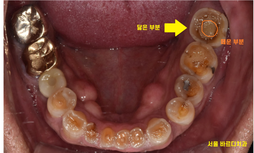 망월동 치과 신경치료 후 보철 꼭 씌워야 하나요?? 관련 이미지 6