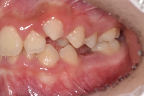 When Should My Child Start Orthodontic Treatment? When to Begin Now vs. When It Is Fine to Wait image 4