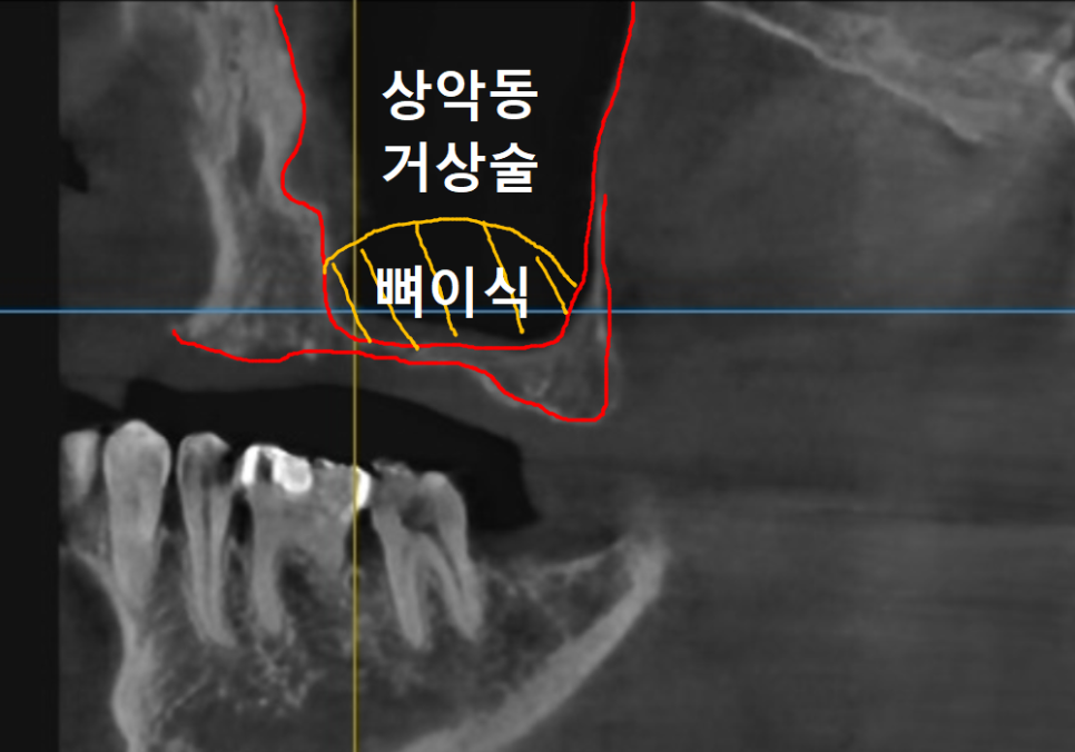 뼈가 없어서 안 된다구요? 70대 당뇨 무치악 환자분의 전체 임플란트 사례 관련 이미지 5