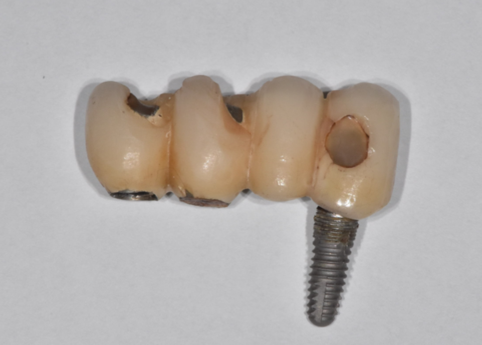 덕풍동 치과 오래된 임플란트 제거 후 재식립하였습니다. 관련 이미지 7