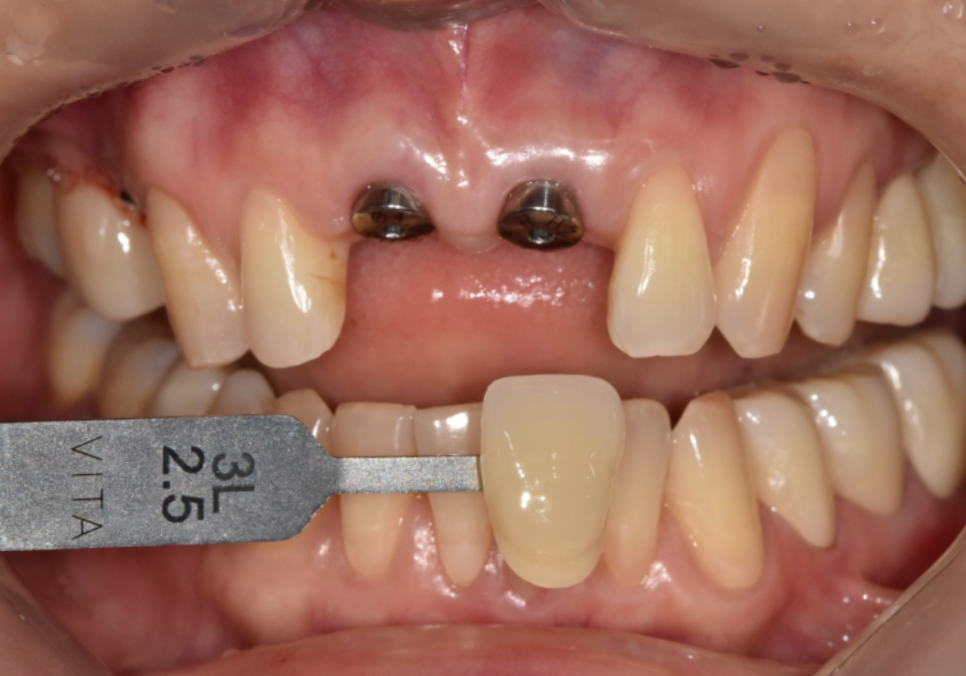 잇몸 까매짐 원인,증상,치료 방법 오래전에 앞니 씌운 곳 잇몸이 까매졌어요. 관련 이미지 14