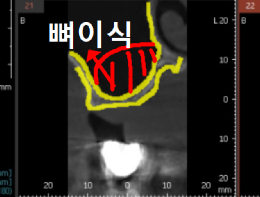 얇은 잇몸뼈, 임플란트 거부 당했다면? 상악동거상술로 해결할 수 있습니다. 관련 이미지 7