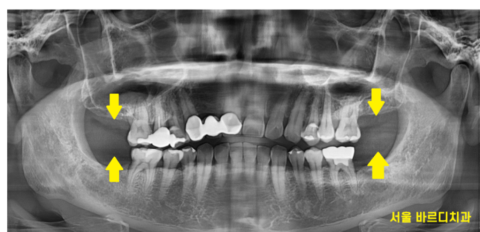 맨 끝 어금니 임플란트 먼저 무너지는 이유가 있습니다. 관련 이미지 1