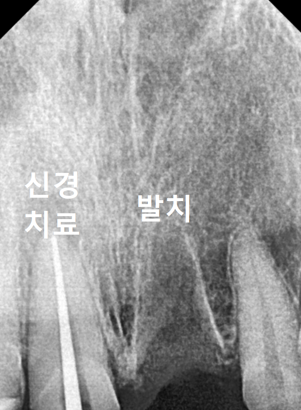 강동구 오래된 보철, 교체 시기는? 아프지 않은데 꼭 바꿔야 하나요? 관련 이미지 15