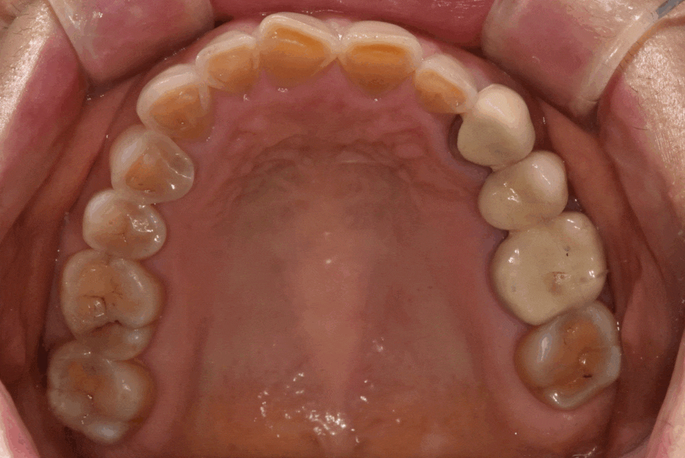 누런 치아 연예인치아 처럼 하얗게 만들 수 있나요? 관련 이미지 4