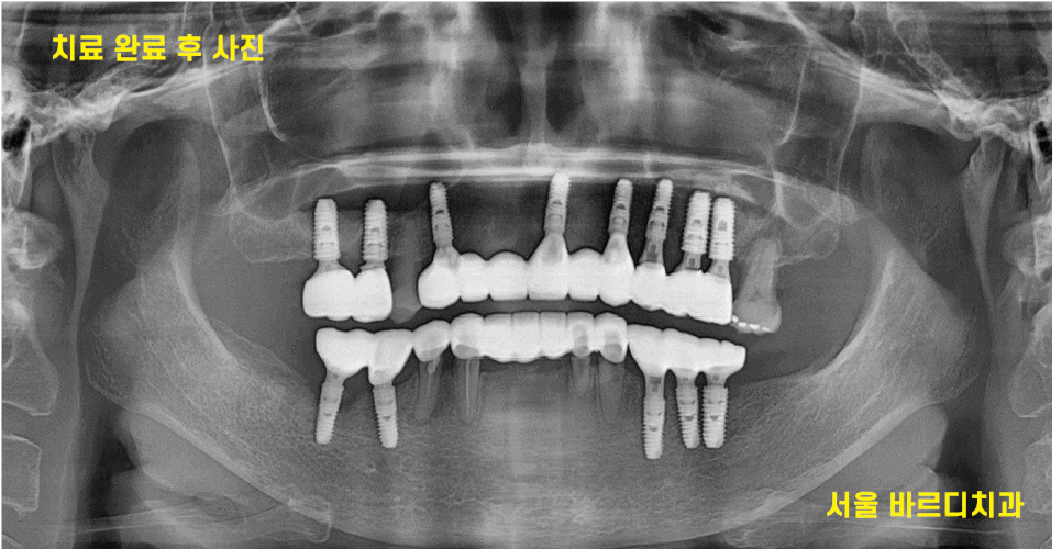 전체적인 치아 치료 13개의 임플란트를 식립한 환자분 관련 이미지 1