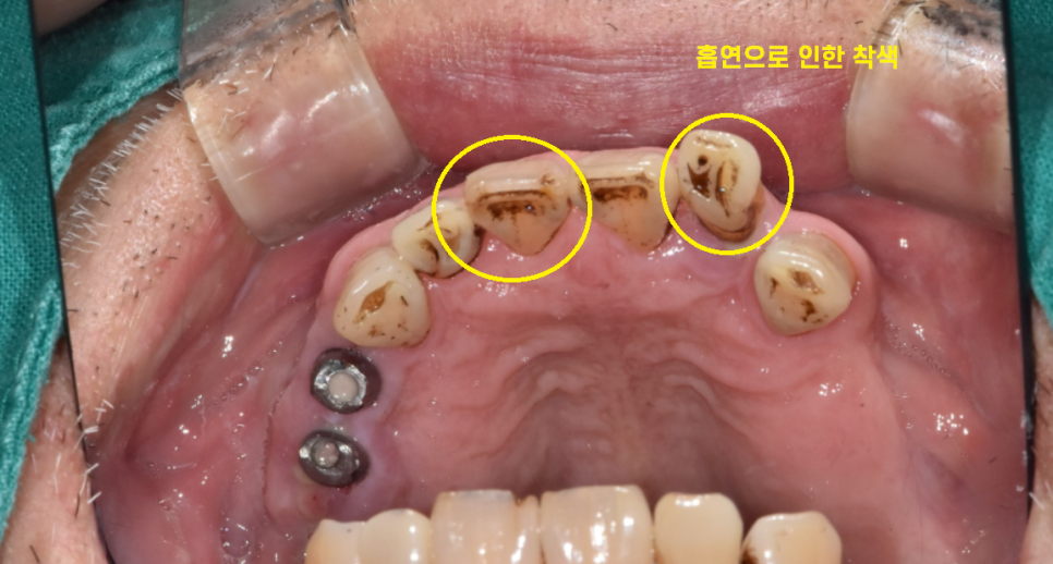 상일동역 근처 치과 타원 임플란트 제거 후 재식립 케이스 관련 이미지 4