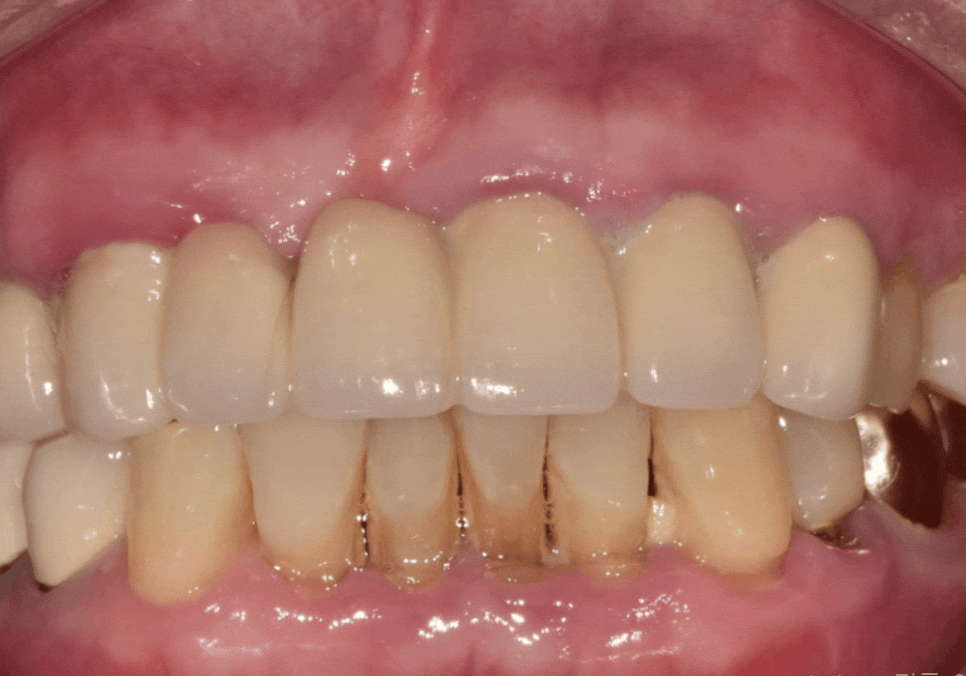 앞니 고름, 잇몸약을 먹어도 왜 염증이 가라앉지 않을까요? 관련 이미지 5