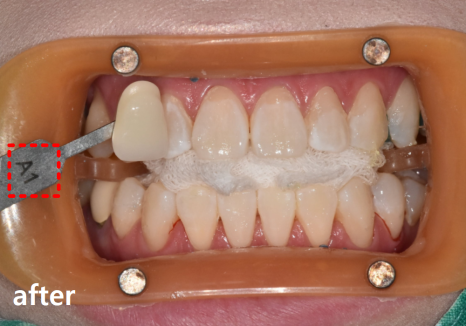 명일동 치과, 미백하면 연예인 치아처럼 새하얘진다는 말, 저는 못하겠습니다. 관련 이미지 12