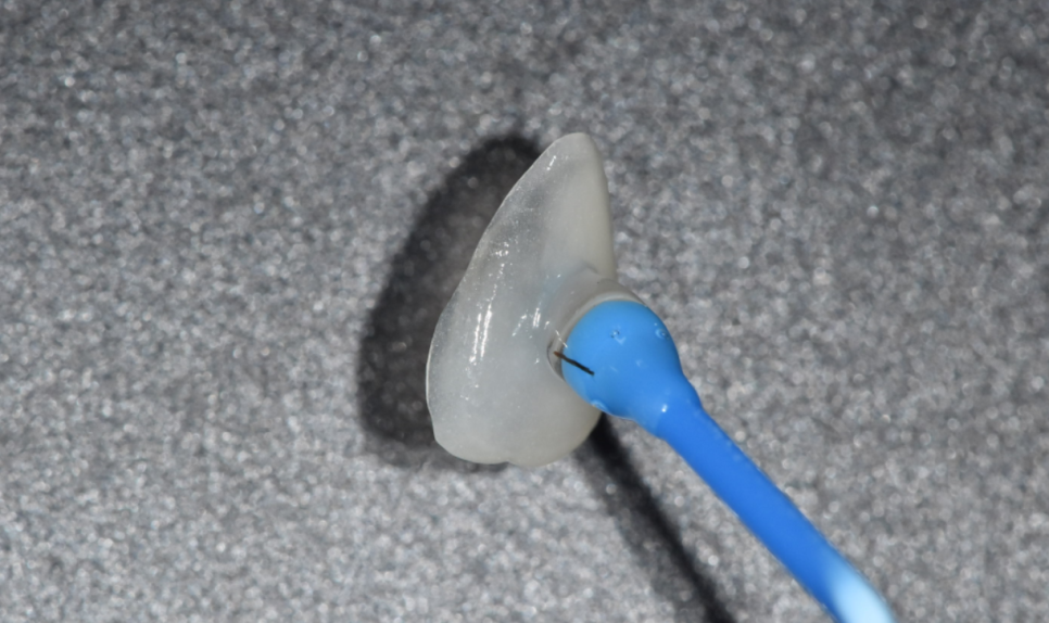 강동구 라미네이트, 치아 하얀 반점 없애고 싶다면? 치료 방법 관련 이미지 9