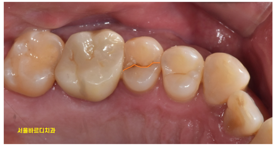 풍산동 치과 어금니 쪼개짐 임플란트를 해야할 때는? 관련 이미지 4