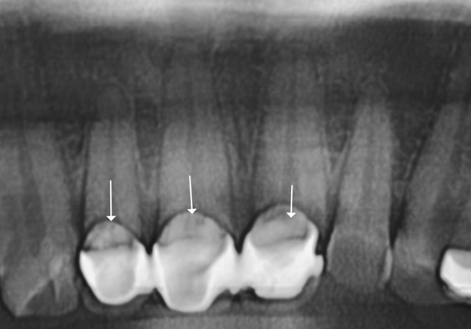 강동구 오래된 보철, 교체 시기는? 아프지 않은데 꼭 바꿔야 하나요? 관련 이미지 2