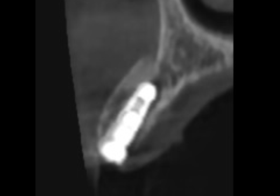 흔들리는 성인 잔존 유치, 50년 만에 송곳니 임플란트 하게 된 사연 관련 이미지 8