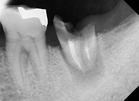 바르디 임플란트는 바르게 심지만, 빠르게 씹습니다. 그간의 경험을 바탕으로요. 관련 이미지 3