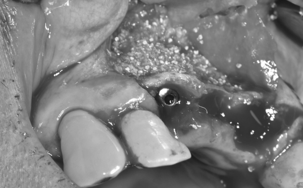 상일동역 치과 윗니 앞니 흔들림 임플란트로 심미까지 잡았습니다. 관련 이미지 7