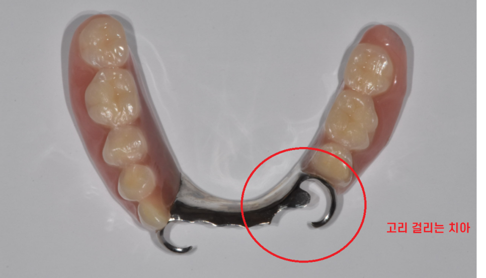 강일동 치과추천 틀니 사용중 치아 부러짐 임플란트로 복구했습니다. 관련 이미지 3