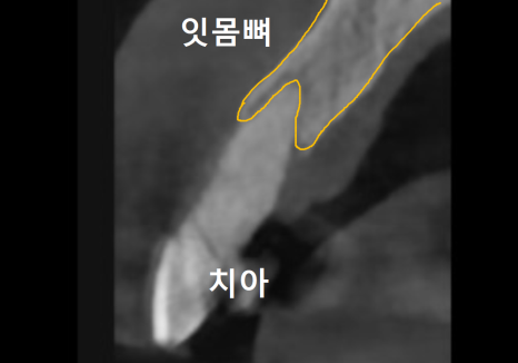 앞니 임플란트, 원내 기공소의 중요성을 아시나요? 관련 이미지 7