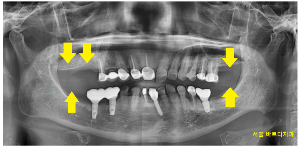 암사동 치과 골다공증 치료 중 임플란트 가능한가요?? 관련 이미지 2