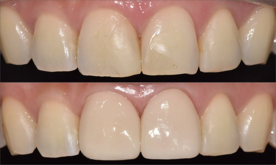 강일역 치과, 검게 보이는 앞니 레진 변색, 무조건 새로 해야 할까요? 관련 이미지 14