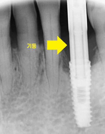 명일동 치과 심미적인 앞니는 하루만에 끝내는 빠른 임플란트로 하세요!! 관련 이미지 8