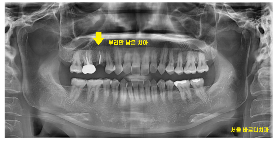 강동구 임플란트 치과 뿌리만 남은 치아 시작이 좋아야 끝도 좋으니까!! 관련 이미지 3