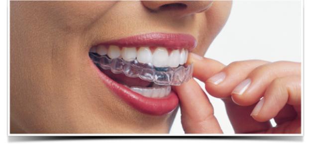 꼈다 뺐다 하는 교정 철사 붙이는건 옛말! 관련 이미지 2