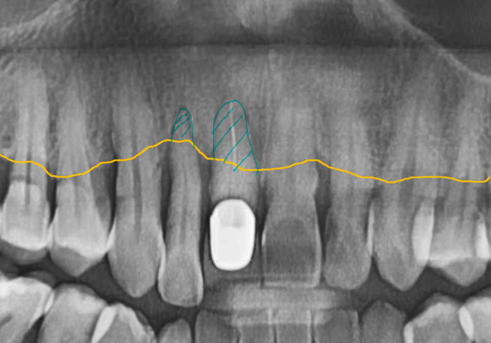 앞니 임플란트, 원내 기공소의 중요성을 아시나요? 관련 이미지 5
