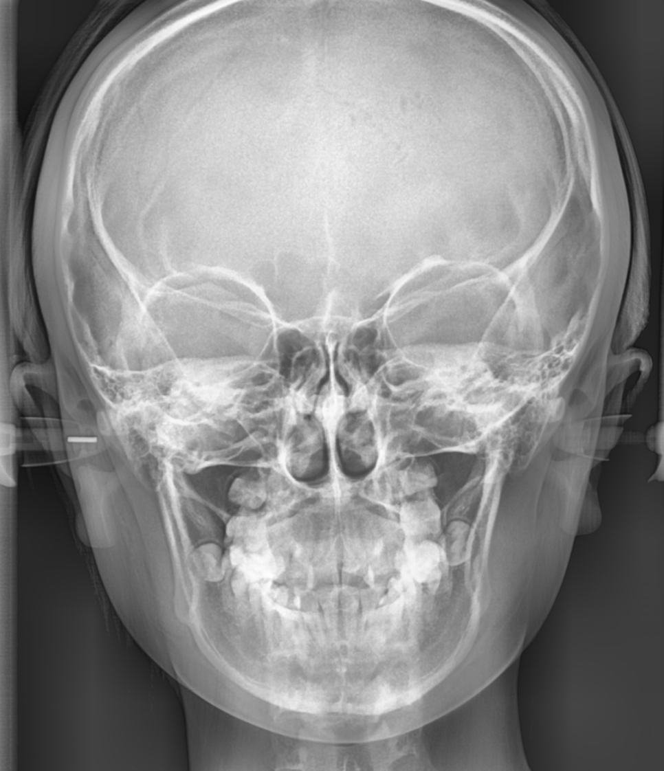 입툭튀 교정 돌출입 수술 없이 가능할까? 관련 이미지 4