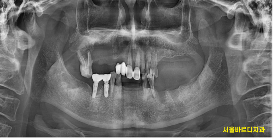 천호동 치과 자연 발치 후 방치된 치아 임플란트 케이스 관련 이미지 1