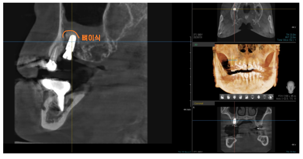 암사동 치과 골다공증 치료 중 임플란트 가능한가요?? 관련 이미지 9