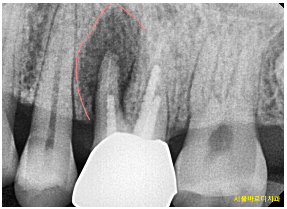 발치후 임플란트 시기 기다려야할까 바로 해야할까? 관련 이미지 4