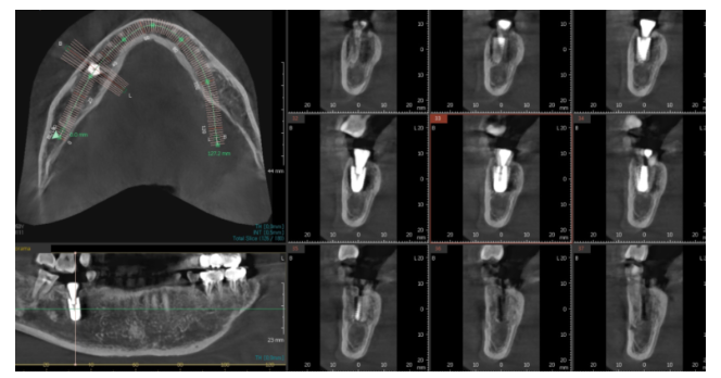 강동구 치과 약먹는게 많은데 임플란트 수술 할 수 있나요?? 관련 이미지 7
