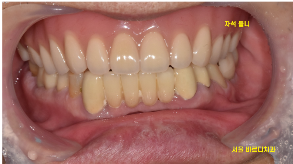 고덕역 치과 전체 치아 상실 시 자석 틀니 오버덴쳐가 해답이 될 수 있습니다. 관련 이미지 5