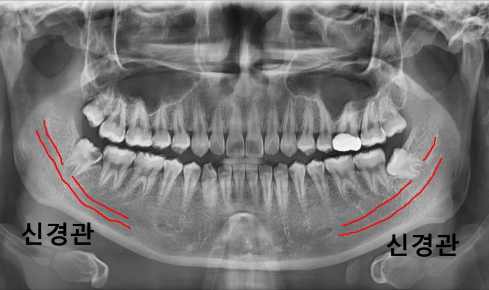 상일동 사랑니 매복 방치하다 옆 치아까지 망가진 실제 사례 관련 이미지 7