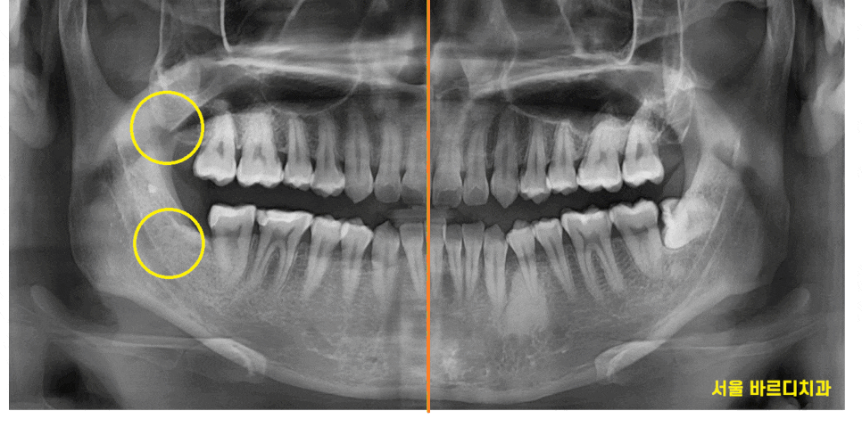 상일동 사랑니 발치  시간, 비용 절약하는 3가지 꿀팁 공개~! 관련 이미지 1