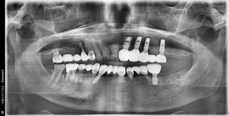 A Pimple Outside the Gums: Bridge Retreatment Implant Case Due to Bone Loss image 6