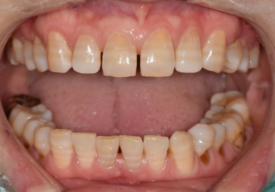 앞니 변색, 치아미백효과 없는 이유 솔직하게 말씀드립니다. 관련 이미지 5