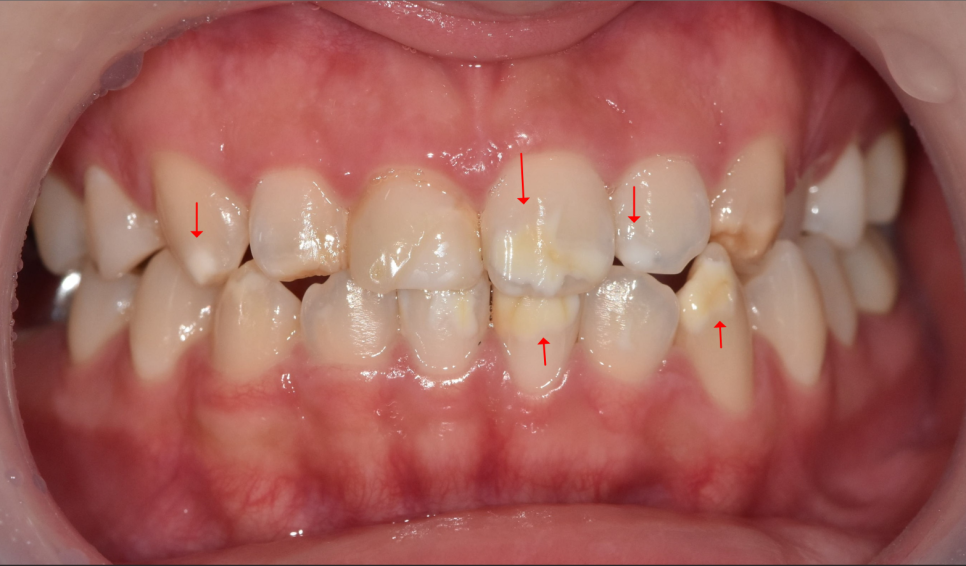 강동구 라미네이트, 치아 하얀 반점 없애고 싶다면? 치료 방법 관련 이미지 2