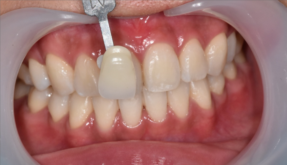 강동구 치아 미백 과정 확인하고 환한 미소로 웃어봐요 우리 관련 이미지 9